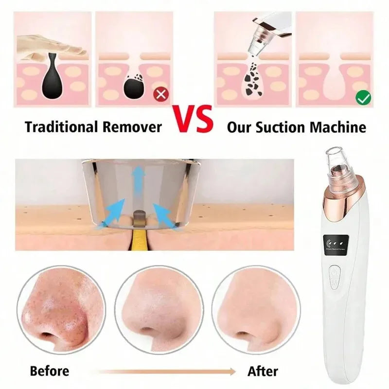 Blackhead Remover Vacuum – Electric Facial Pore Cleanser