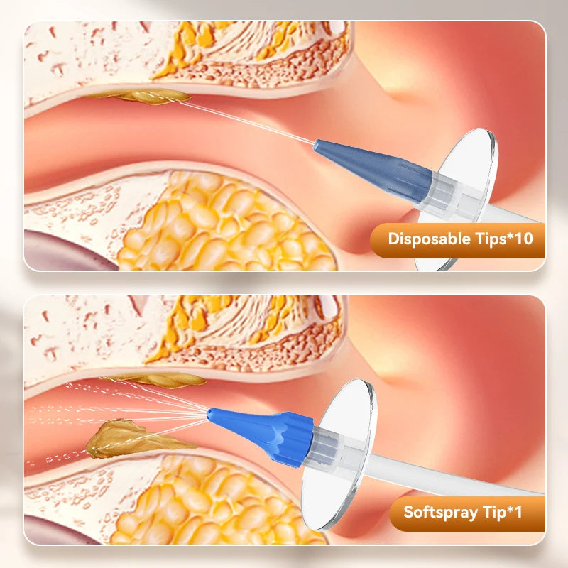 Ear Wax Removal Kit – Safe Water Irrigation Flushing System